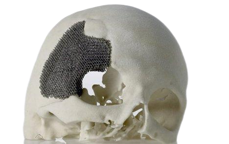 金属3D打印在骨科植入物领域的应用.png